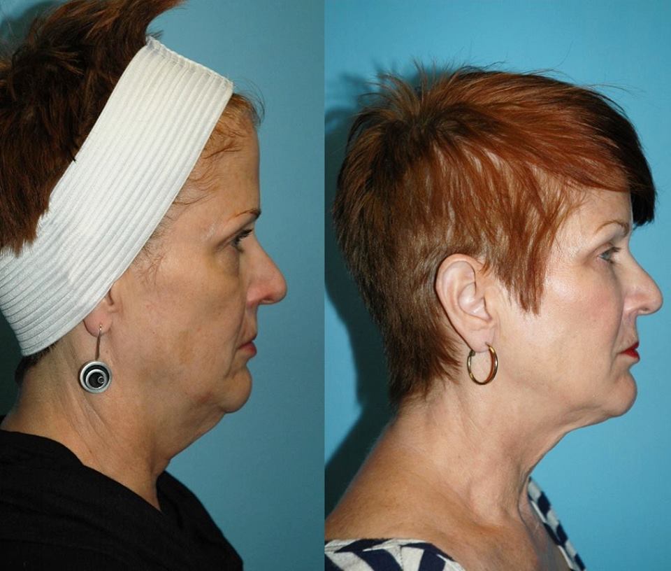 dr. tracy leong san diego kybella patient before and after