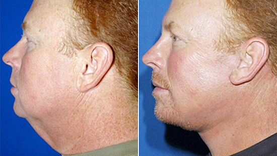 neck liposuction for double chin san diego